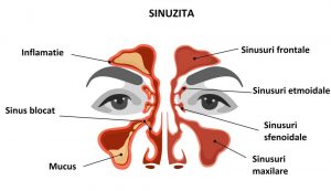 sinuzita afectează vederea